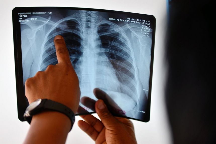 Vide ar zemu skābekļa saturu var pasliktināt TB bojājumus plaušās